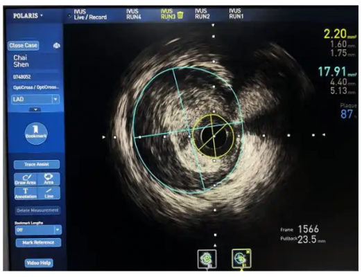 血管內超聲影像處理軟件into ivus